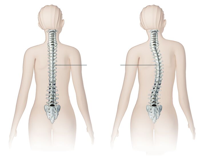 mellkasi gerinc osteochondrosisának gyógyszeres kezelése)